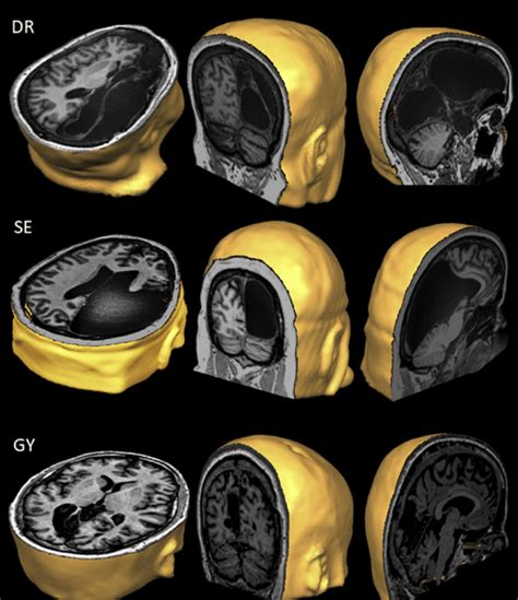 Sections Of T1 Weighted 3t Mri Anatomical Scans Of Dr Top Se