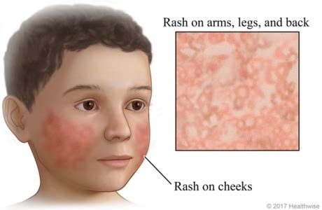 Fifth Disease Rash Cigna