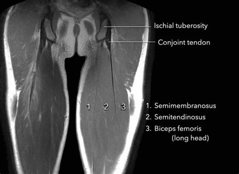 The Radiology Assistant Hamstring Injury
