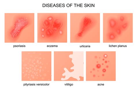 Skin Diseases And Disorders Pictures