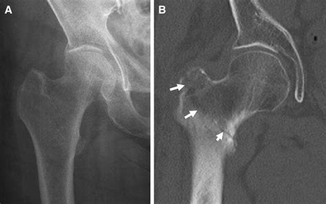 86 Year Old Woman With A Radio Occult Intertrochanteric Fracture