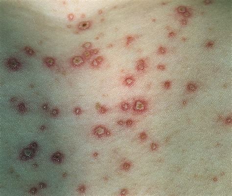 Does Shingles Always Have A Rash Or Blisters