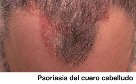 Conozca En Fotos Los Tipos De Psoriasis