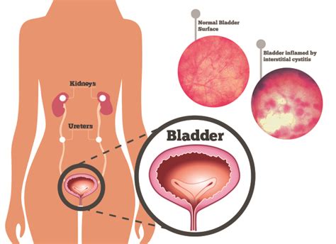 How To Manage Interstitial Cystitis Bladder Pain Syndrome