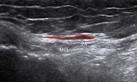 Accuracy And Efficacy Of Ultrasound Guided Pes Anserinus Bursa Injection Intechopen