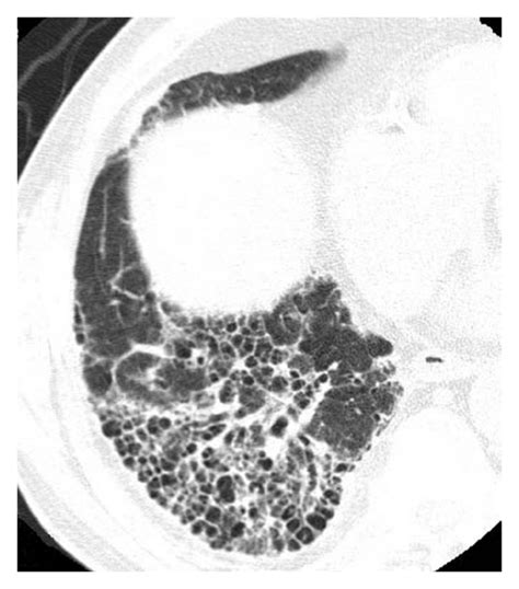 Diffuse Interstitial Pneumonia Uip Pattern With Emphysema A Chest
