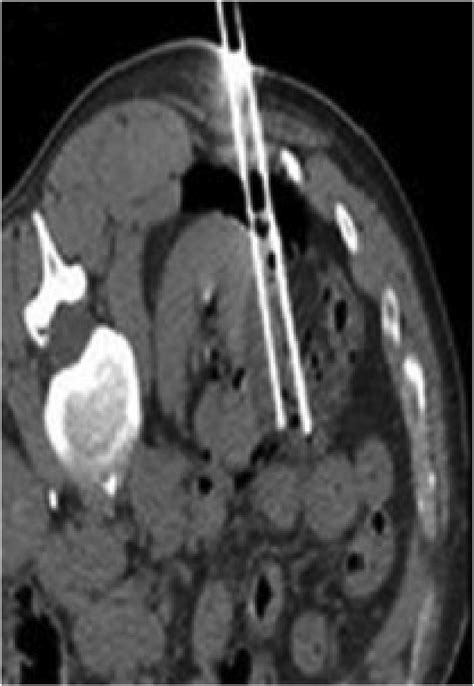 Percutaneous Cryoablation Monitoring Of The Cortical Tumour At The