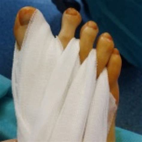 A propos de la chirurgie mini invasive et percutanée du pied