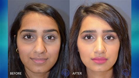 Rhinoplasty Nose Job Experience Before And After Youtube