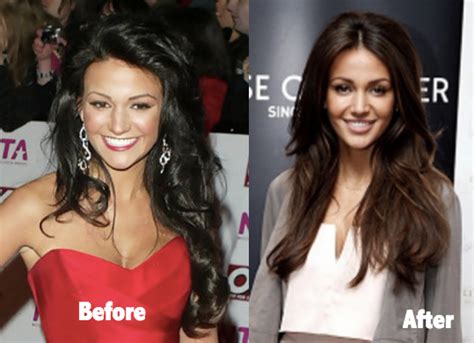 Michelle Keegan Before Plastic Surgery After Lip Fillers