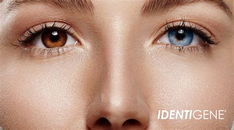 Dna And Heterochromia Two Different Colored Eyes Identigene