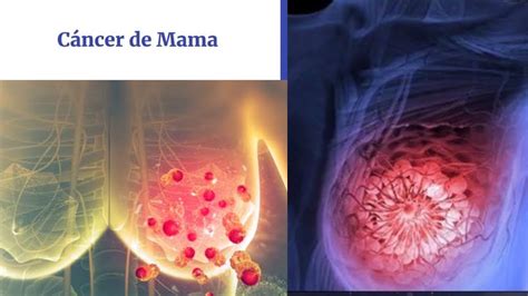 Cáncer De Mama Anatomía Básica Concepto Clasificación Detección Temprana Y Diagnóstico Youtube
