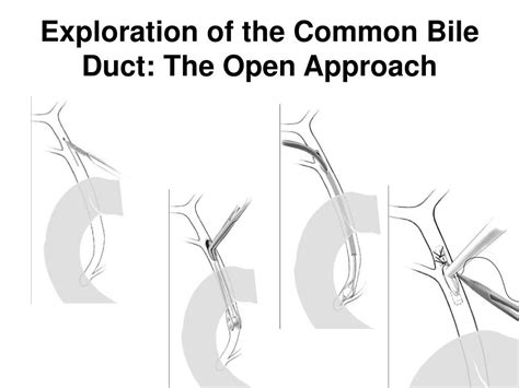 Ppt Exploration Of The Common Bile Duct The Open Approach Powerpoint