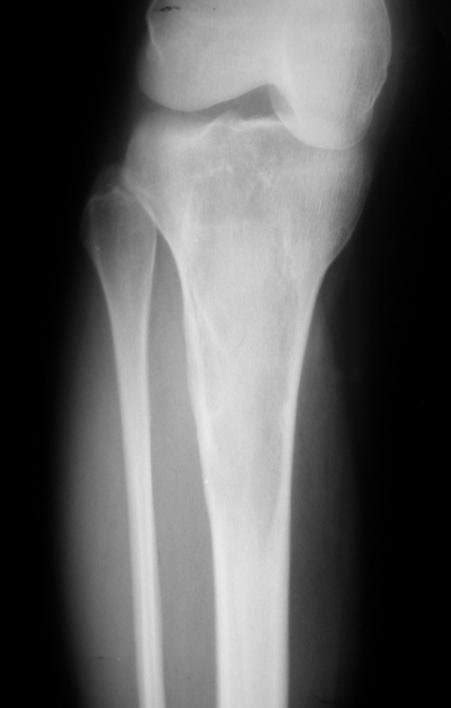 A And B X Ray Of The Right Tibia Showing Metaphyso Diaphyseal Cystic