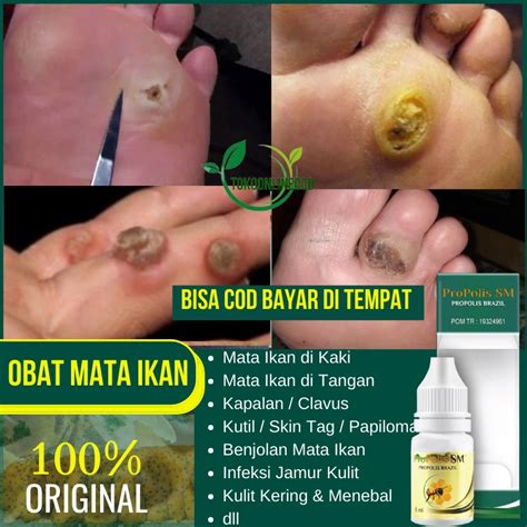 Jual Obat Mata Ikan Di Telapak Kaki Mata Ikan Di Kaki And Tangan Salep Penghilang Mata Ikan