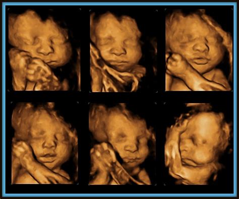 List Of Best Time For 3d Ultrasound Twins 2022 Download App