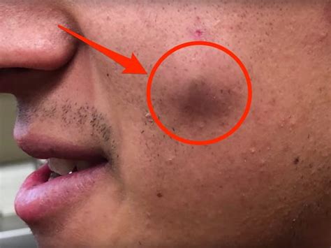 Dr Pimple Popper Video Shows A Cheek Cyst Full Of Oatmeal Insider