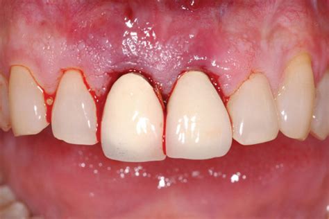 An Updated Approach To Ridge Preservation Oral Health Group