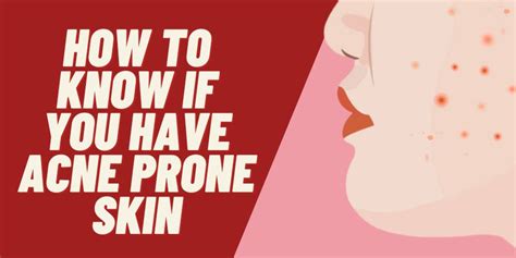 How To Know If You Have Acne Prone Skin Must Read