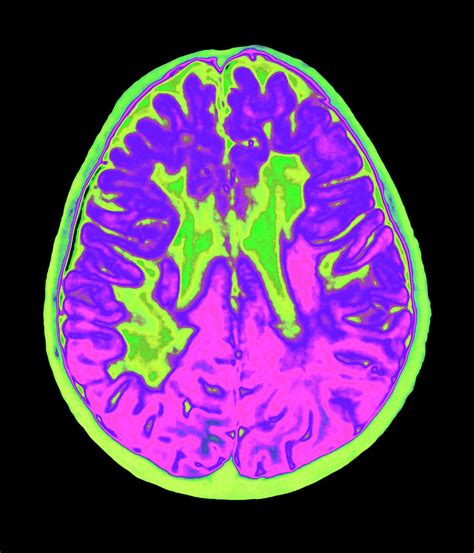Coloured Mri Brain Scan Showing Multiple Sclerosis Photograph By Mehau