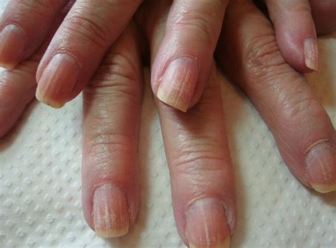 Page contents vitamin deficiencies that causes brittle nails brittle nails and hair loss vitamin deficiency | conclusion Nails The Best Vitamins For Nails | KSTYLICK - Latest ...