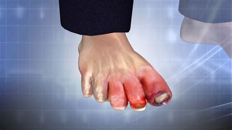 Swollen Toe Treatment Causes Symptoms Youtube