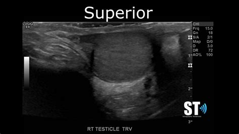 Testicularscrotal Doppler Protocol Sonographic Tendencies