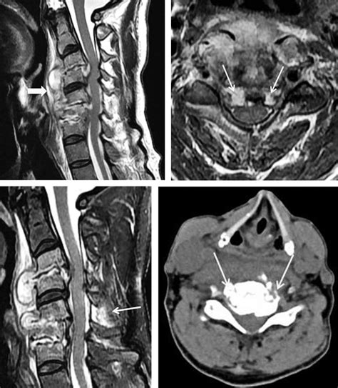 A Cervical T2 Weighted Sagittal Magnetic Resonance Mr Image Shows A