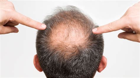 Bald Spot In Hair Home Interior Design