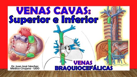 VENA CAVA SUPERIOR e INFERIOR Anatomía Venas BRAQUIOCEFÁLICAS