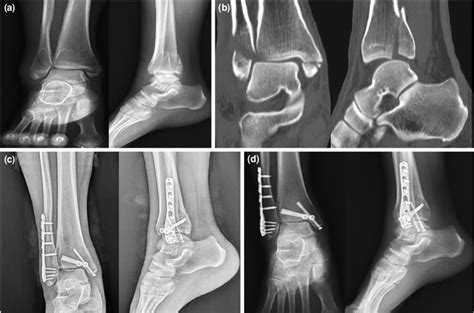 Images Of Patients With Supination Lateral Rotation Ankle Fractures