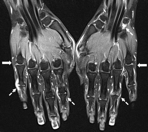 Bilateral Mr Imaging Of The Hand And Wrist In Early And Very Early
