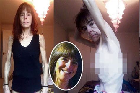 Anorexic Mum Who Weighs Just Five Stones Pleads With Nhs Not To Let Her