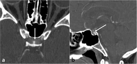 A And B Axial And Sagittal Contrast Enhanced Computed Tomography