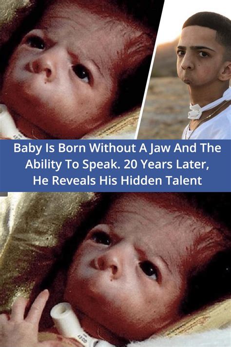 Baby Is Born Without A Jaw And The Ability To Speak 20 Years Later He