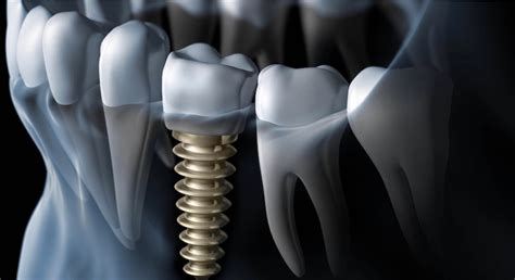 Causes Of Dental Implant Failure What You Need To Know