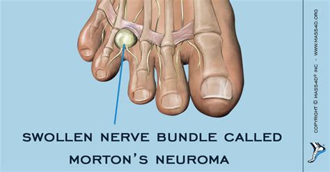 Causes And Symptoms Of Mortons Neuroma Mass4d Insoles Mass4d