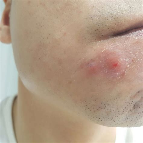 Does Anyone Know What This Is Red Lump General Acne Discussion