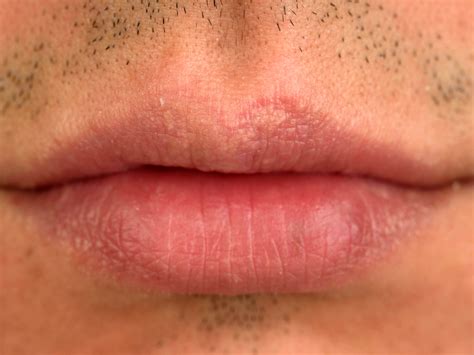 Fordyce Spots On Lips Treatments Lipstutorial Org