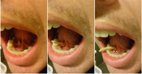Watch This Man Push A Salivary Stone Out Of His Mouth And Be Changed