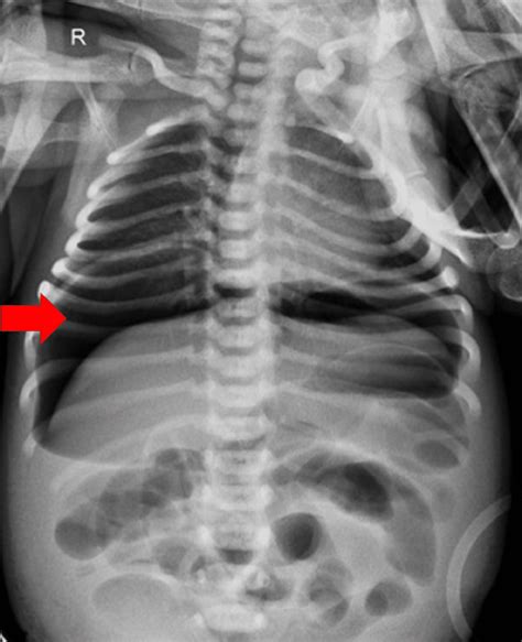 Cureus Spontaneous Intestinal Perforation In Neonates Involving The Cecum A Case Report