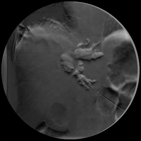 In oracle, you can create your own procedures. Reintervention in percutaneous biliary drainage | Eurorad