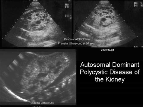 Polycystic Kidney Disease Ultrasound