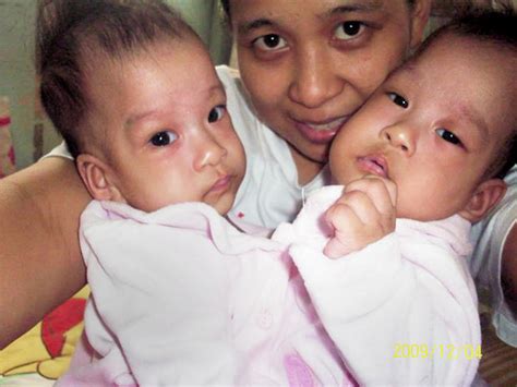 Formerly Conjoined Sabuco Twins How Are They Now Photo 21