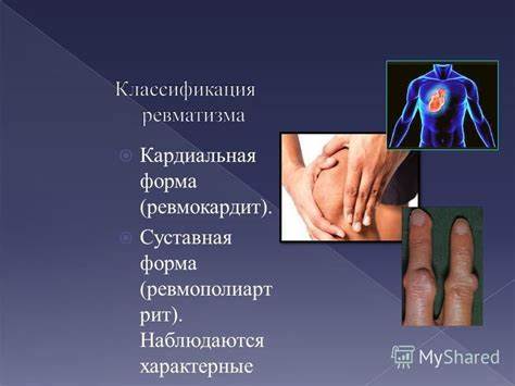 Ревматическая хорея диета Презентация на тему: "Что такое – ревматизм? Классификация ревматизма Презентация на тему: "Что такое – ревматизм? Классификация ревматизма Ревматическая хорея диета