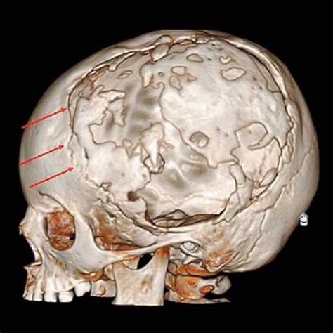 Pdf Use Of A 3d Skull Model To Improve Accuracy In Cranioplasty For
