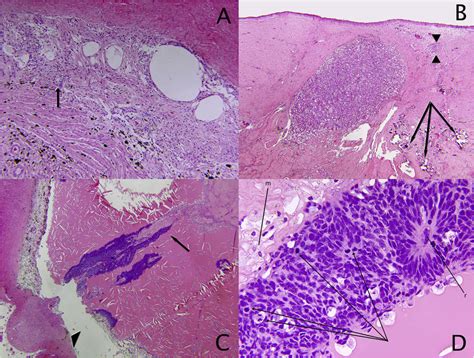 Histopathology Of The Enucleated Globe Hande Stain A In The Ciliary