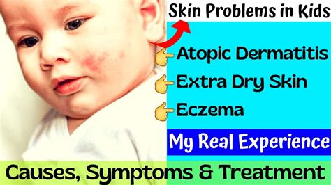 Baby Eczemadry Skin Causessymptoms Andtreatment How To Treat Atopic