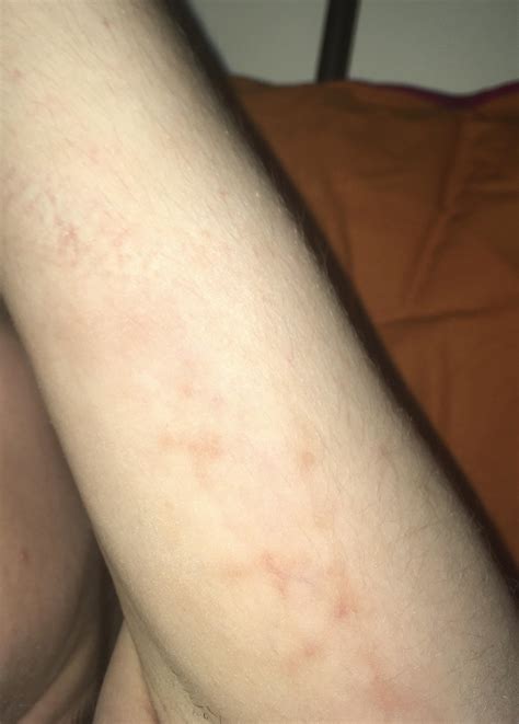 What Is This Weird New Rash On My Arm Dermatologyquestions