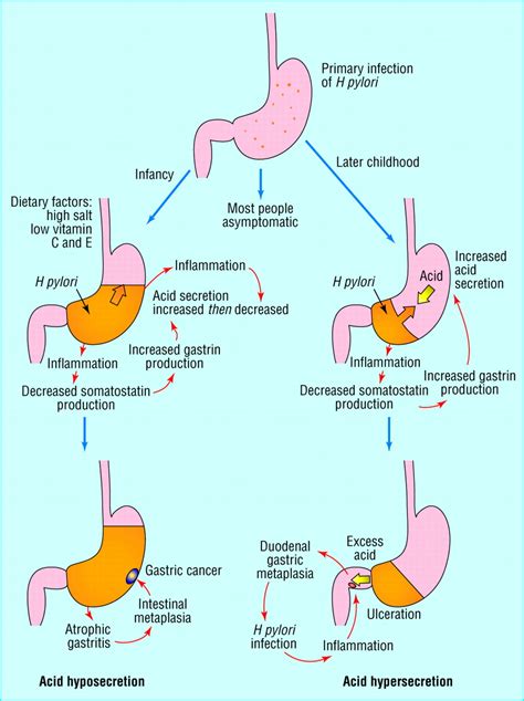 Pathophysiology Of Duodenal And Gastric Ulcer And Gastric Cancer The Bmj